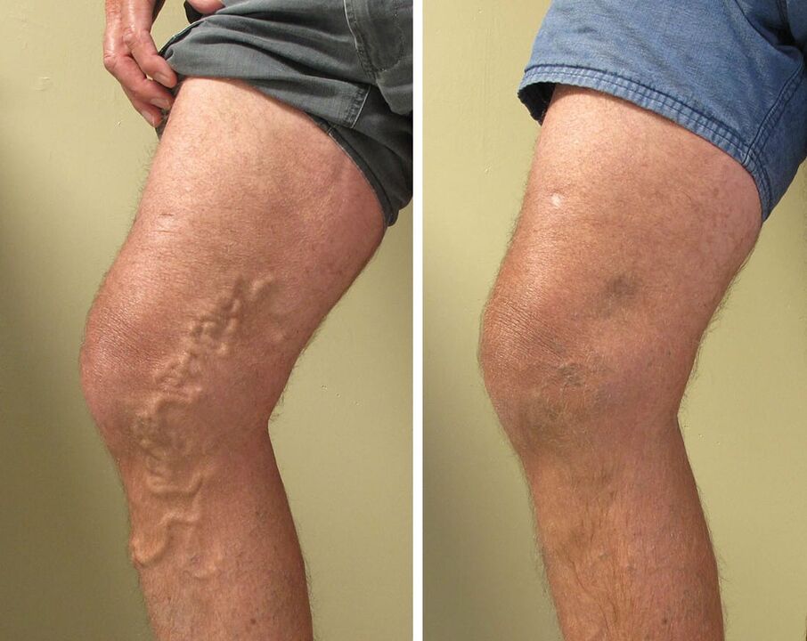 Опит от използването на GEL Vasaxal